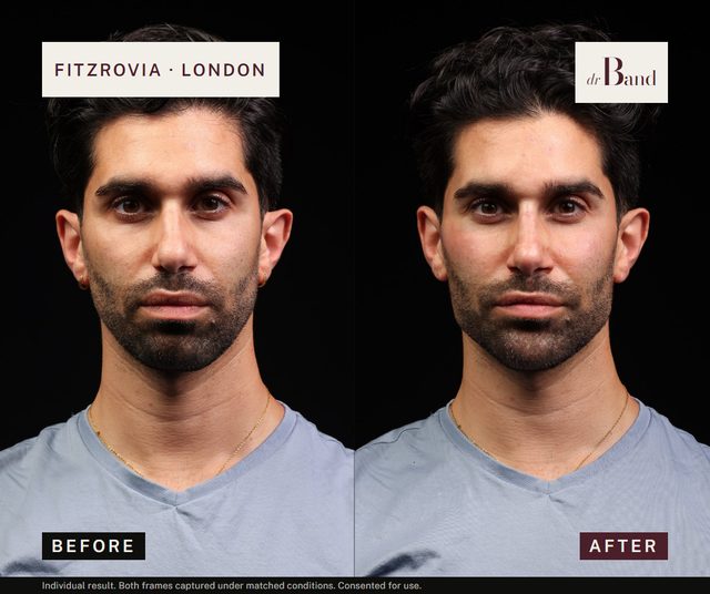 Before and after, full-face harmonisation by Dr Band