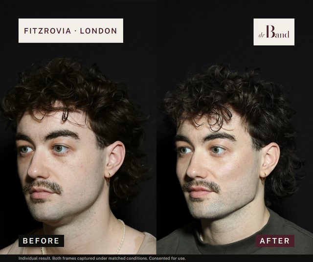 Before and after, full-face harmonisation by Dr Band