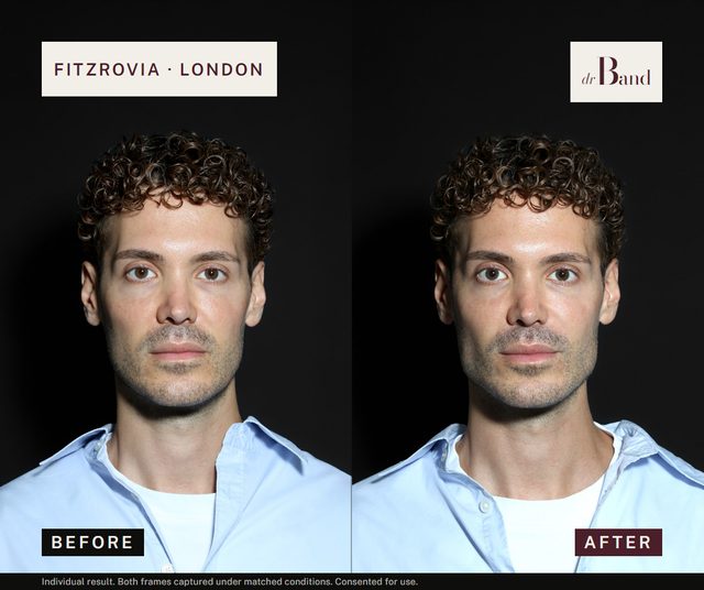 Before and after, full-face harmonisation by Dr Band