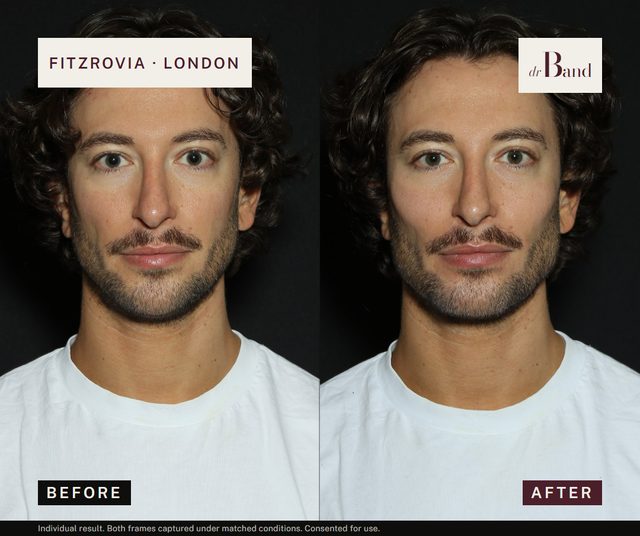 Before and after, full-face harmonisation by Dr Band