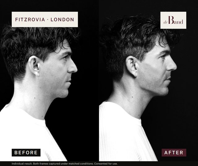 Before and after, full-face harmonisation by Dr Band