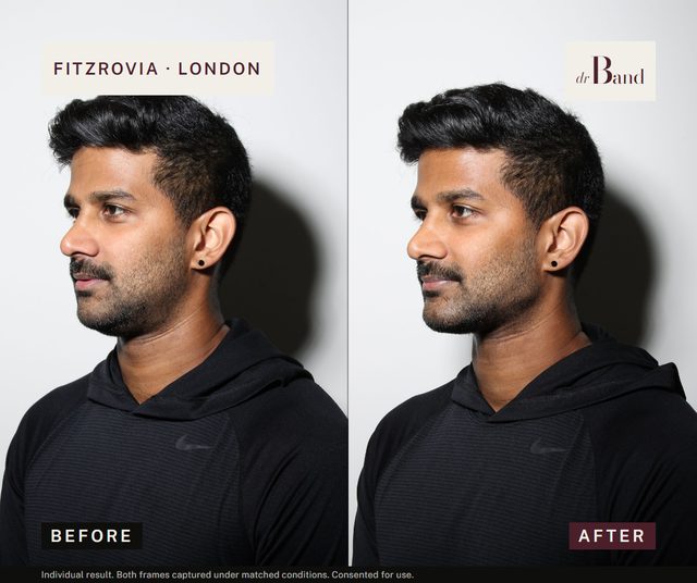 Before and after, full-face harmonisation by Dr Band
