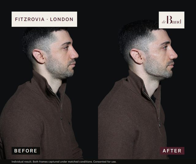 Before and after, full-face harmonisation by Dr Band