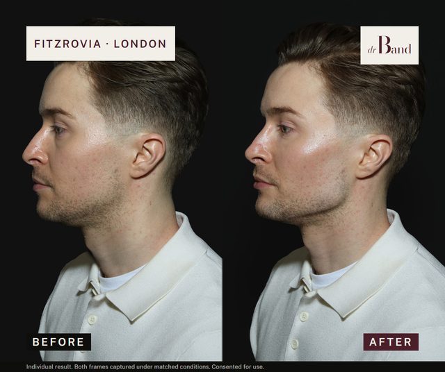 Before and after, full-face harmonisation by Dr Band