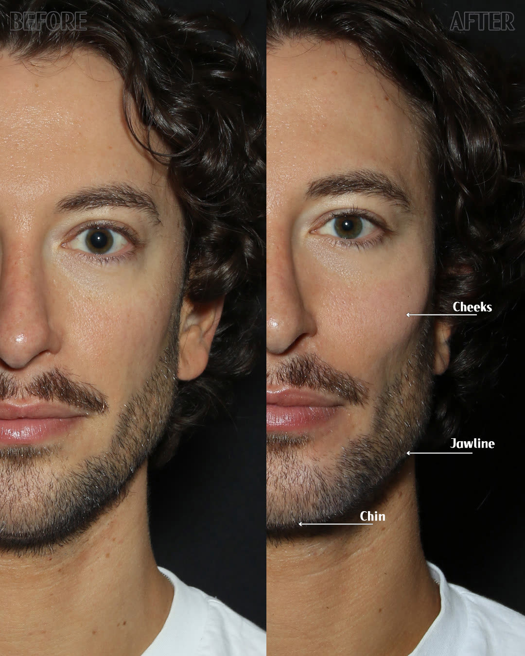 drBand patient after jawline and chin filler, lower-third definition, unretouched