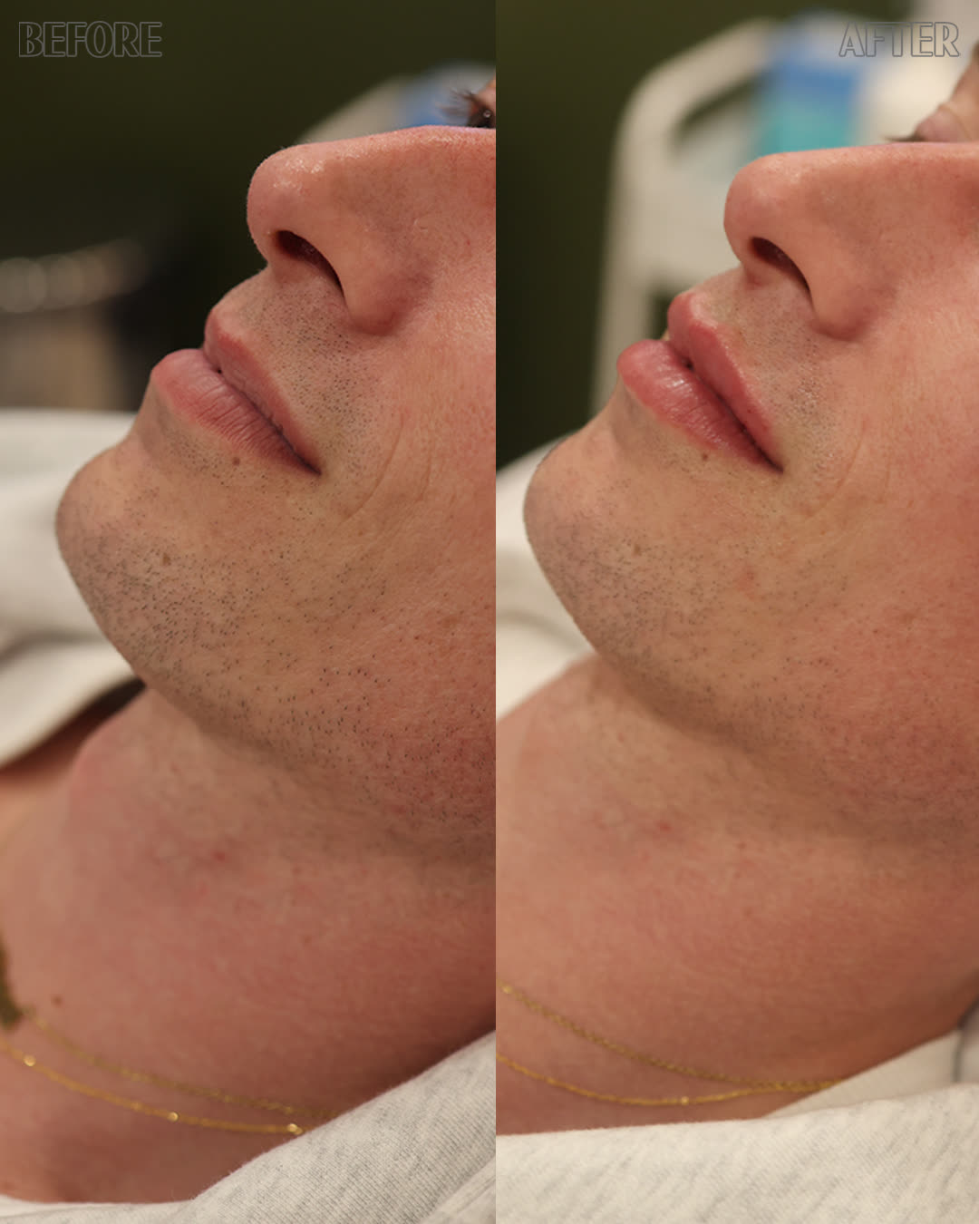 Mid-face support, unretouched
