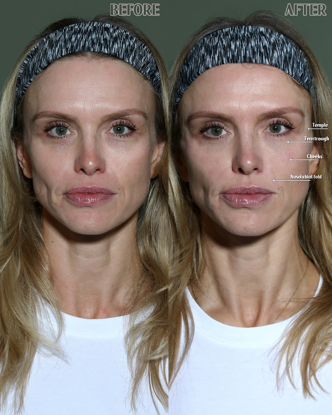 Patient after cheek and chin refinement, three-quarter view
