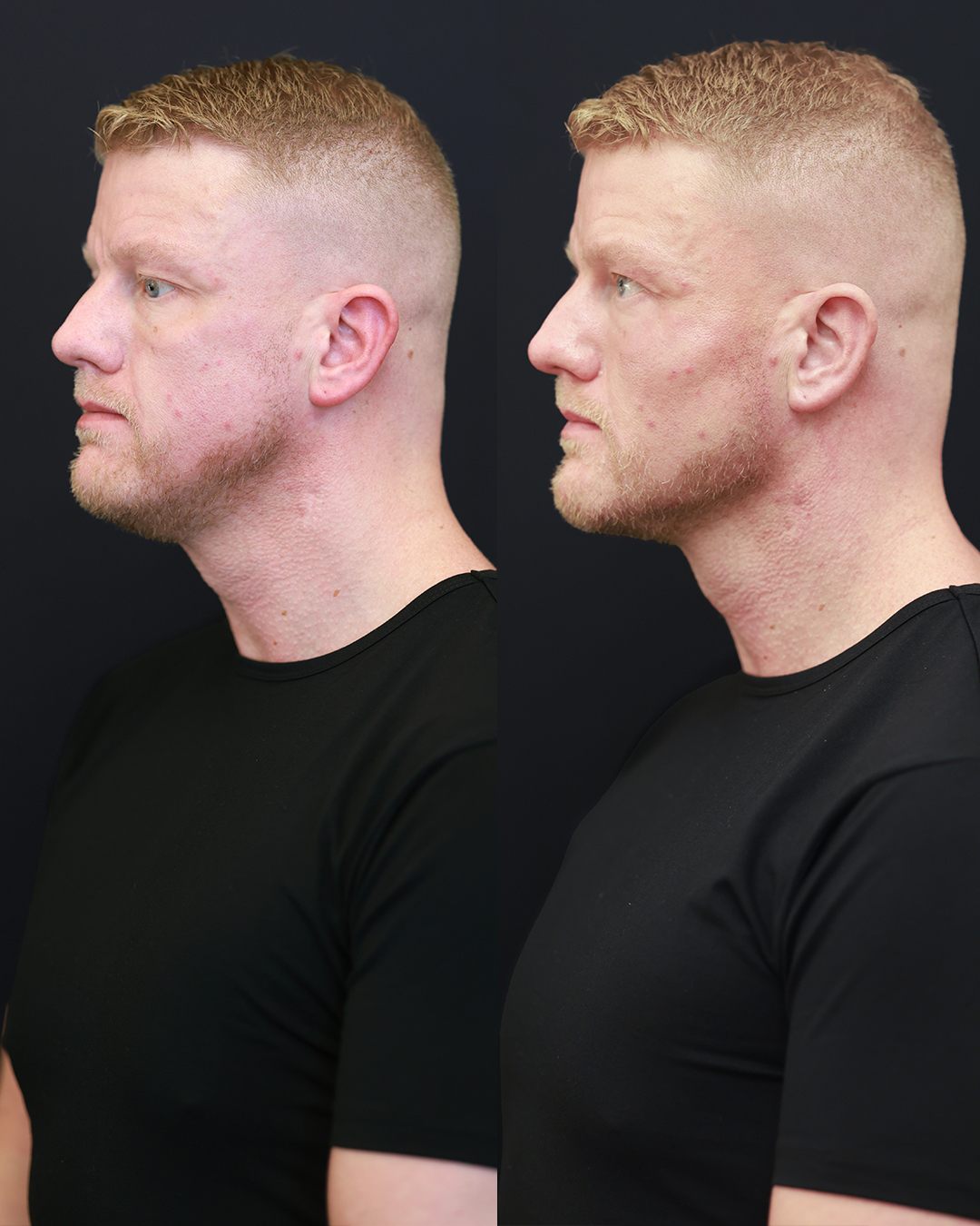 Male patient before and after, lower face and jawline definition, profile view, unretouched