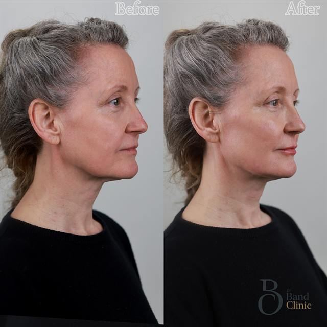 Unretouched before and after result, the drBand Clinic