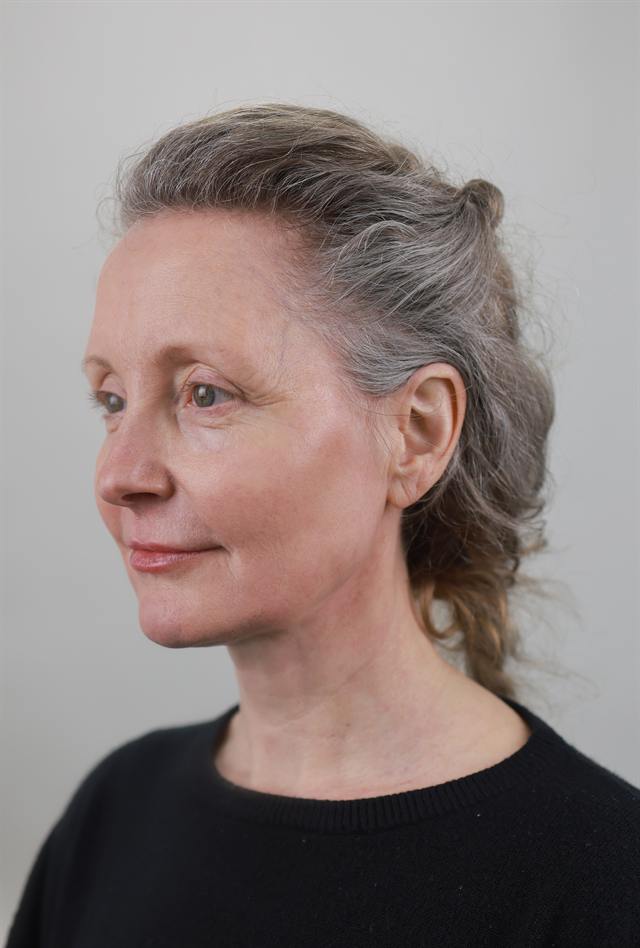 Unretouched before and after result, the drBand Clinic