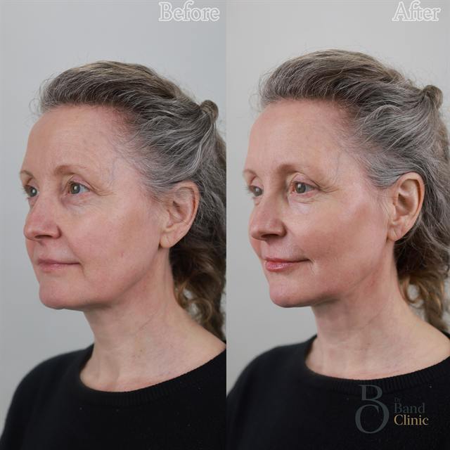 Unretouched before and after result, the drBand Clinic
