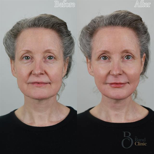 Unretouched before and after result, the drBand Clinic