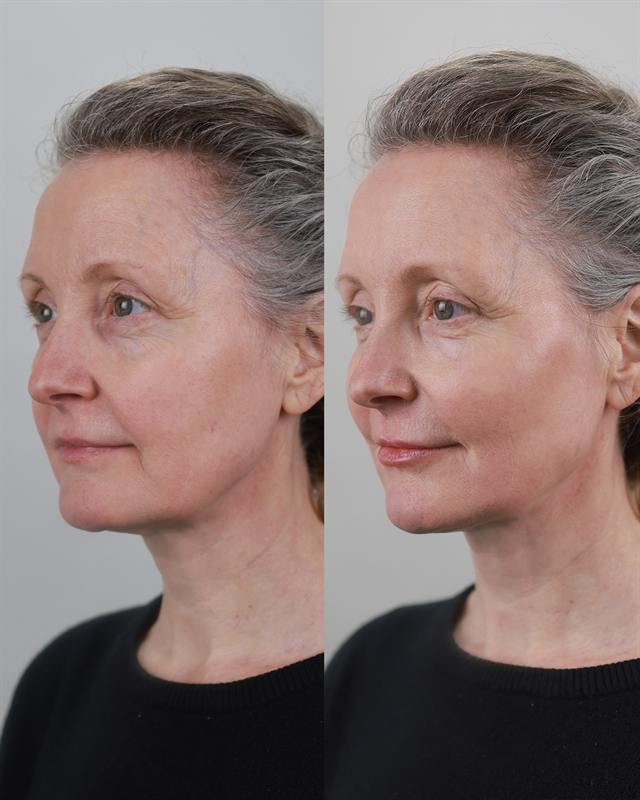 Unretouched before and after result, the drBand Clinic