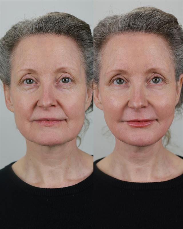 Unretouched before and after result, the drBand Clinic