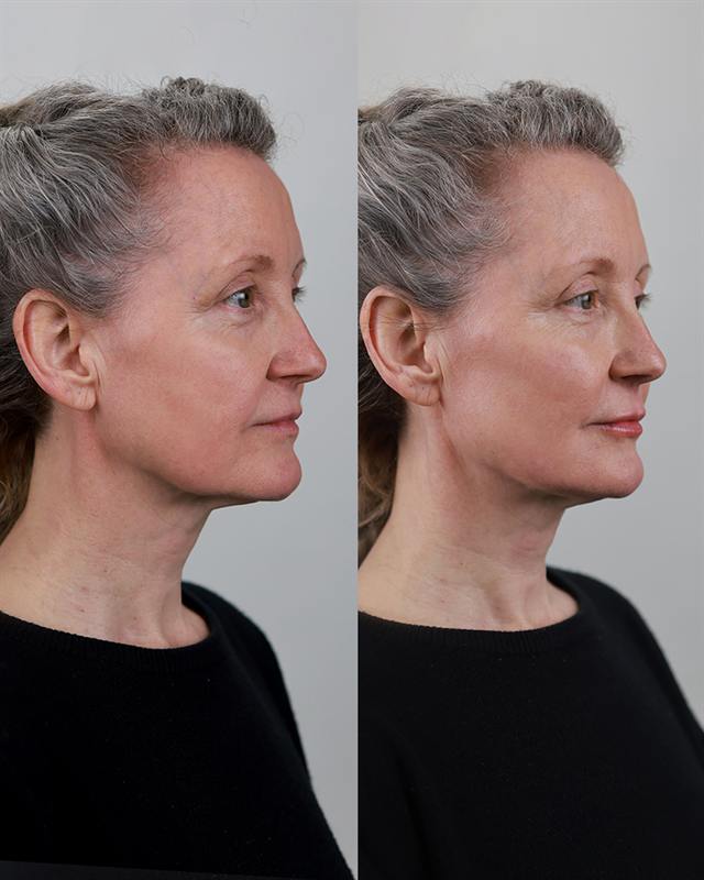 Unretouched before and after result, the drBand Clinic
