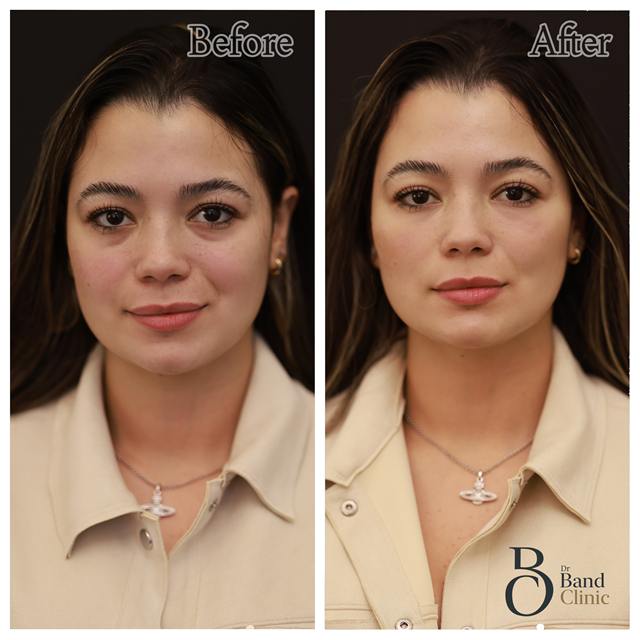 Unretouched before and after result, the drBand Clinic