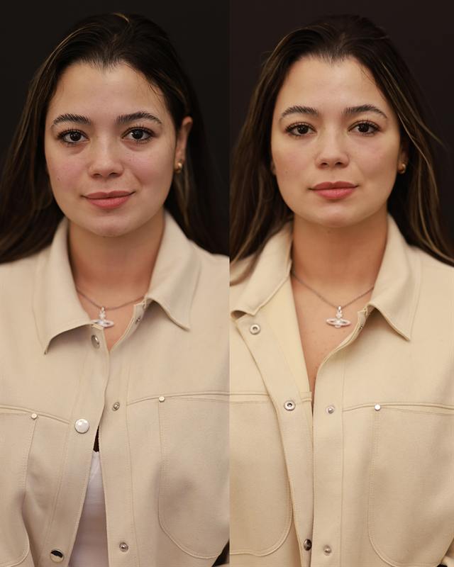 Unretouched before and after result, the drBand Clinic