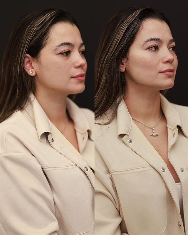 Unretouched before and after result, the drBand Clinic