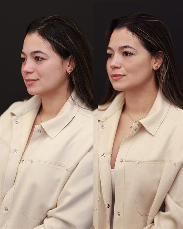 Unretouched before and after result, the drBand Clinic