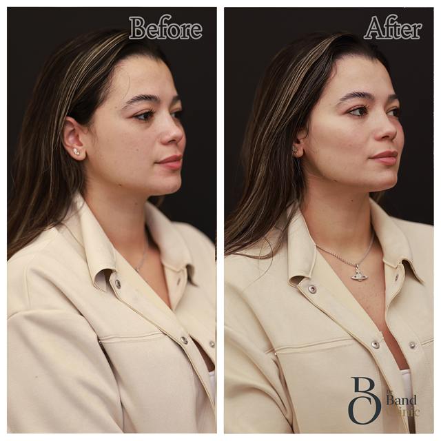 Unretouched before and after result, the drBand Clinic