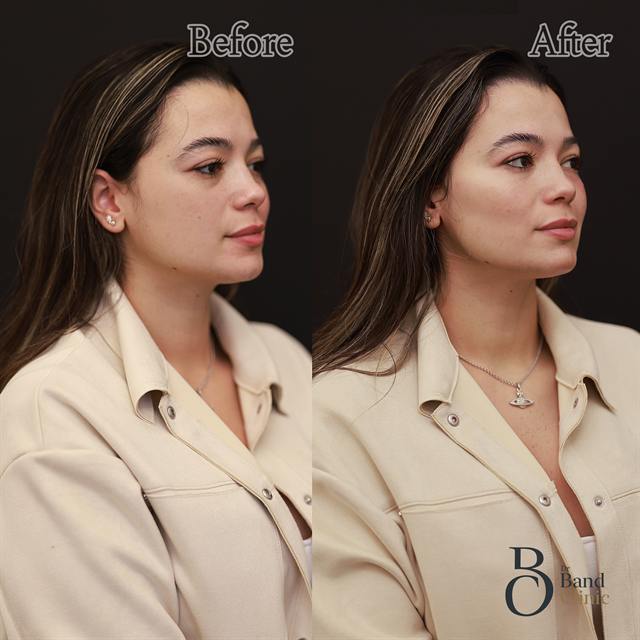 Unretouched before and after result, the drBand Clinic