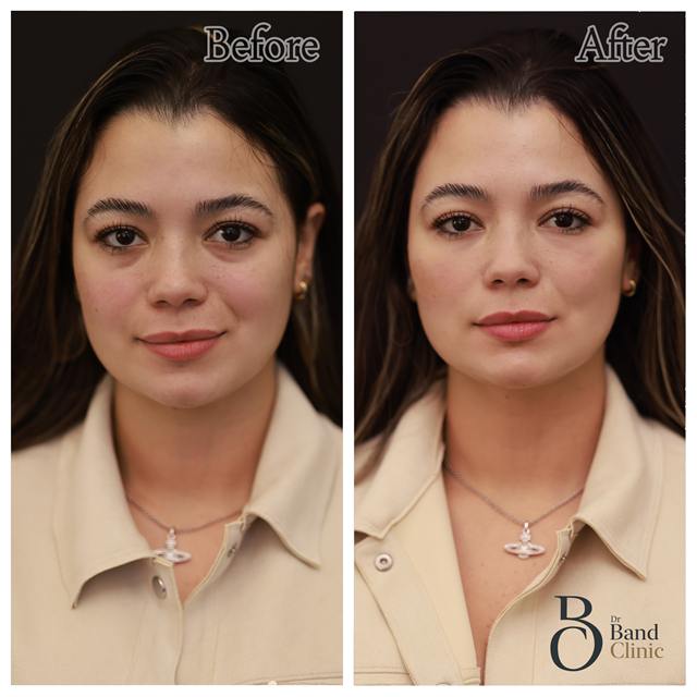 Unretouched before and after result, the drBand Clinic