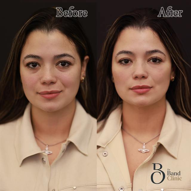 Unretouched before and after result, the drBand Clinic