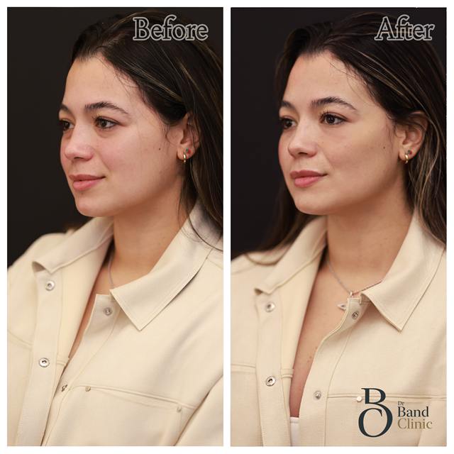 Unretouched before and after result, the drBand Clinic