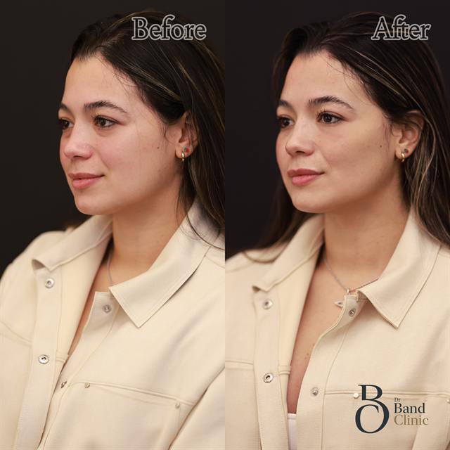 Unretouched before and after result, the drBand Clinic