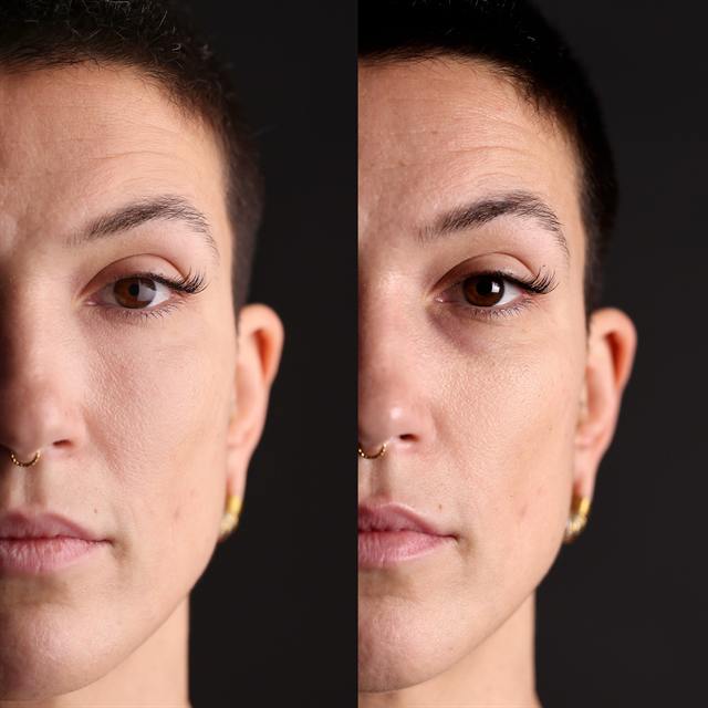 Unretouched before and after result, the drBand Clinic