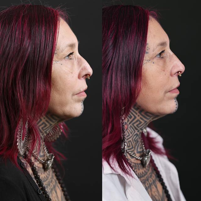 Unretouched before and after result, the drBand Clinic