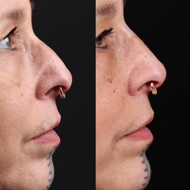 Unretouched before and after result, the drBand Clinic