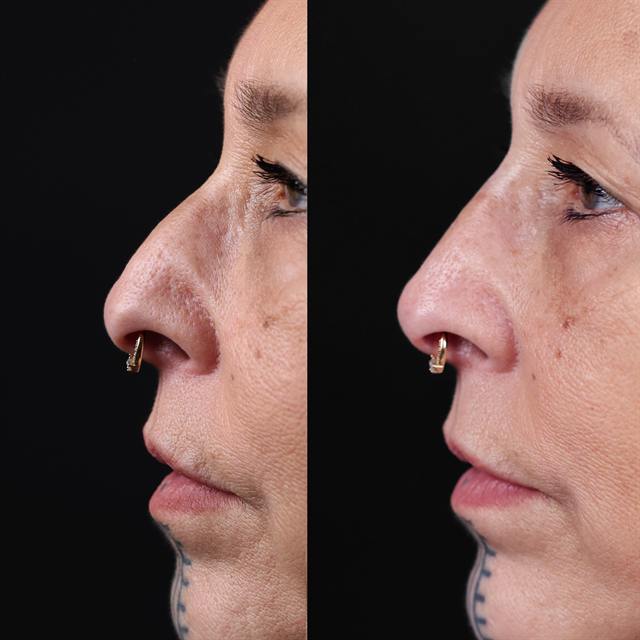 Unretouched before and after result, the drBand Clinic