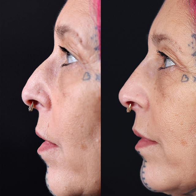 Unretouched before and after result, the drBand Clinic