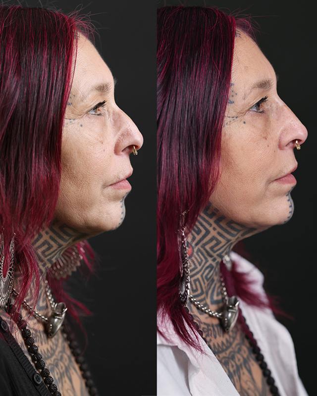 Unretouched before and after result, the drBand Clinic
