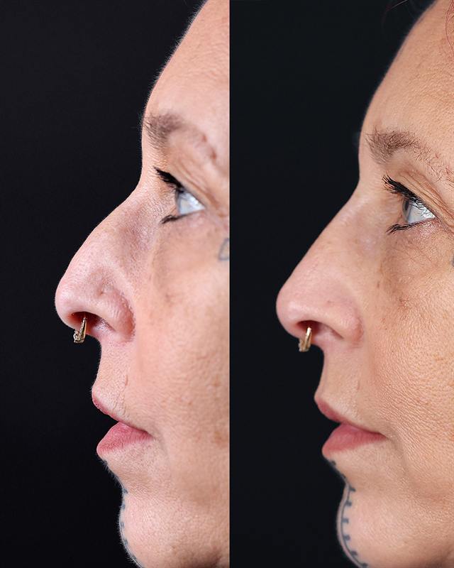 Unretouched before and after result, the drBand Clinic