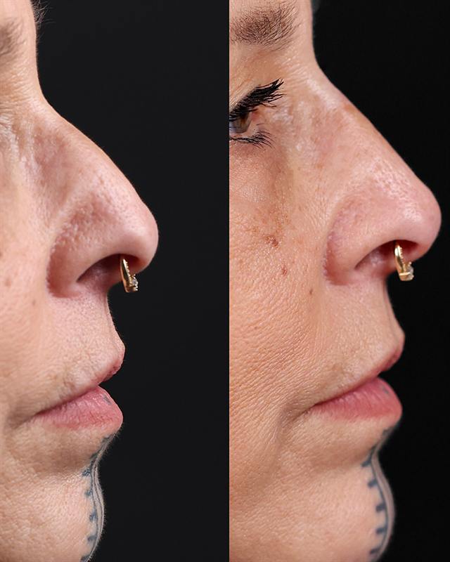 Unretouched before and after result, the drBand Clinic