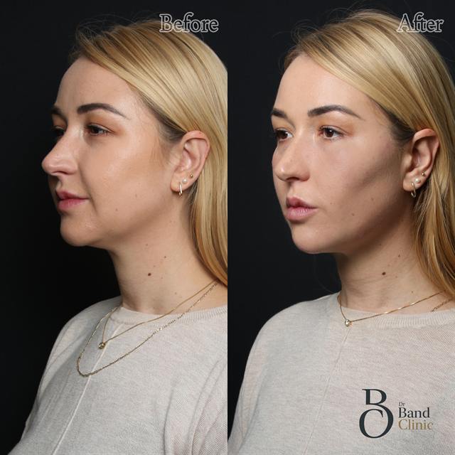 Unretouched before and after result, the drBand Clinic