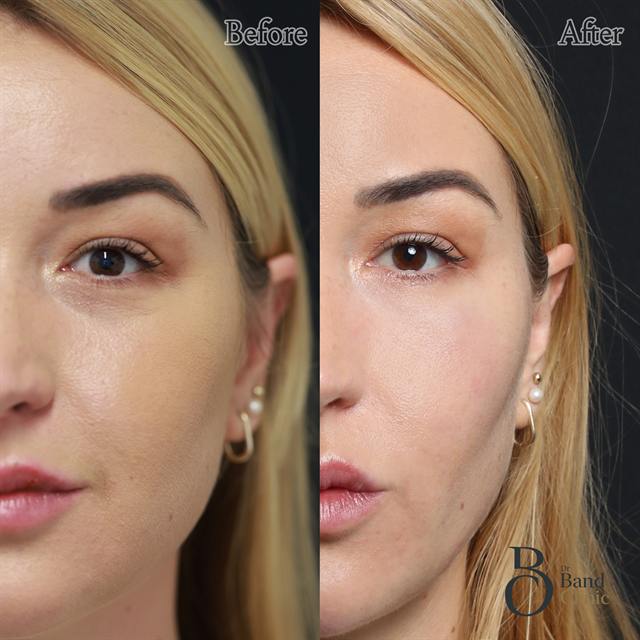 Unretouched before and after result, the drBand Clinic