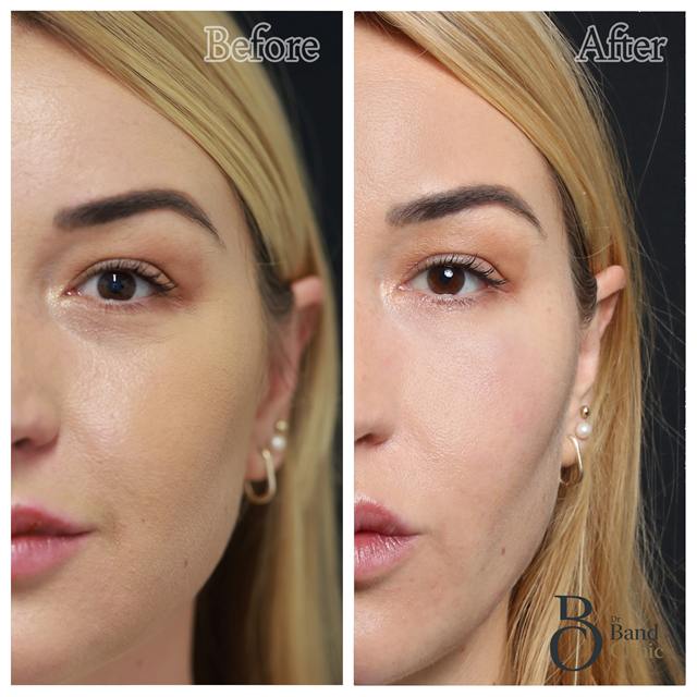 Unretouched before and after result, the drBand Clinic