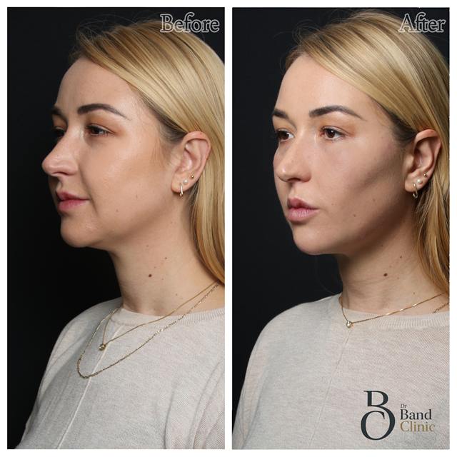 Unretouched before and after result, the drBand Clinic