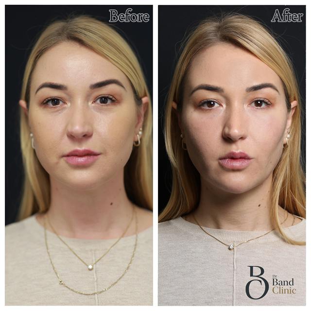 Unretouched before and after result, the drBand Clinic