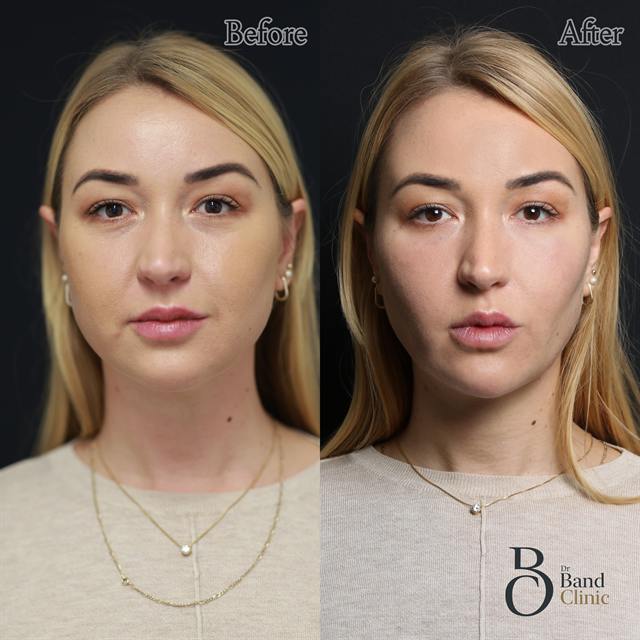 Unretouched before and after result, the drBand Clinic