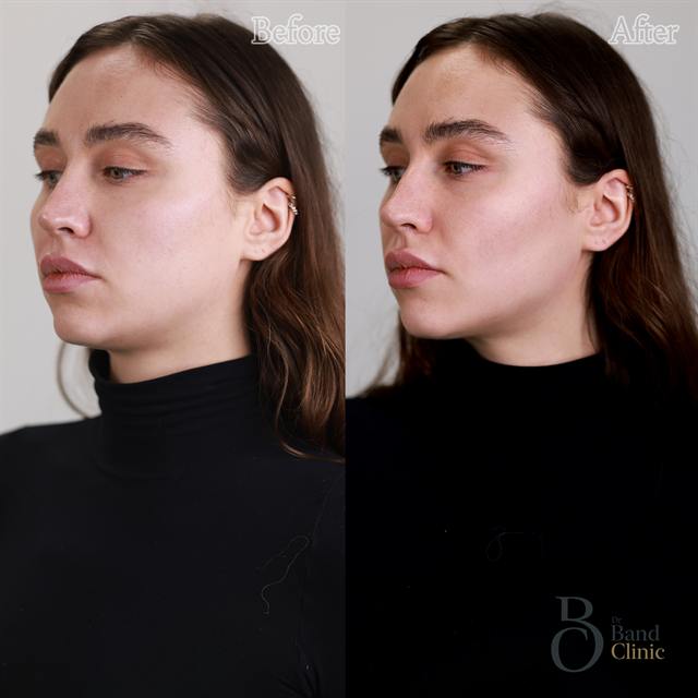 Unretouched before and after result, the drBand Clinic
