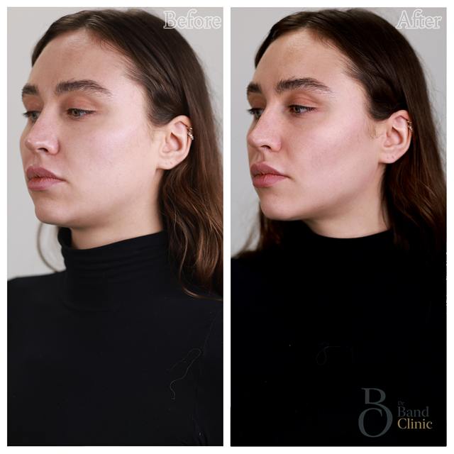 Unretouched before and after result, the drBand Clinic