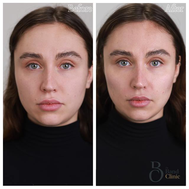 Unretouched before and after result, the drBand Clinic