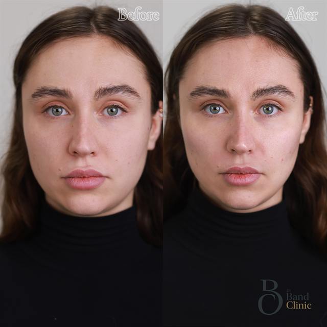 Unretouched before and after result, the drBand Clinic