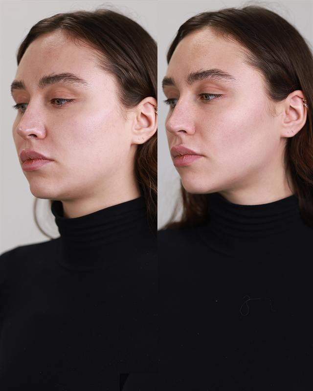 Unretouched before and after result, the drBand Clinic