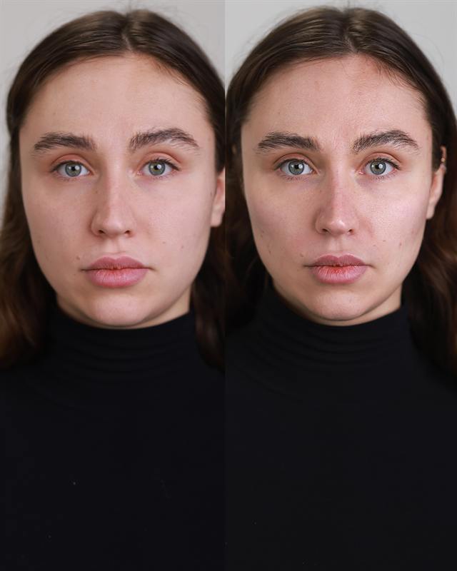 Unretouched before and after result, the drBand Clinic