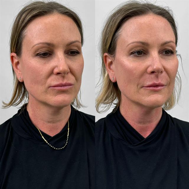 Unretouched before and after result, the drBand Clinic